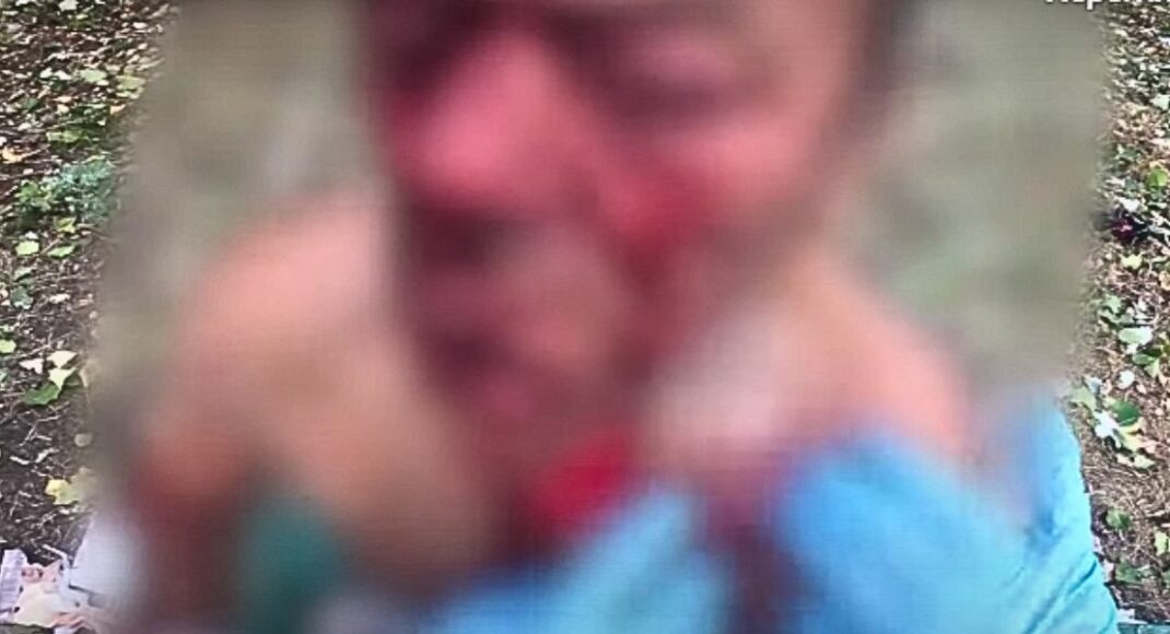 Парамедики поліції Донеччини допомогли пораненому, в якого були осколки в обличчі та зачепило око (відео)